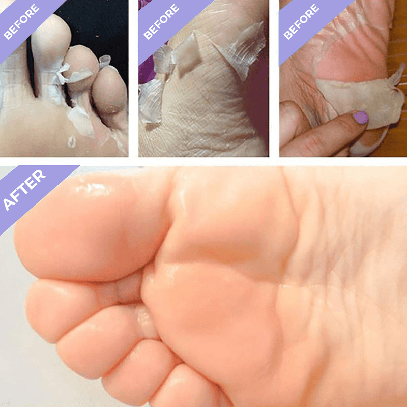 Bliss™ Foot Peel Masks | Exfoliating Callus Remover for Baby Soft Feet | 2 pairs (4 masks)